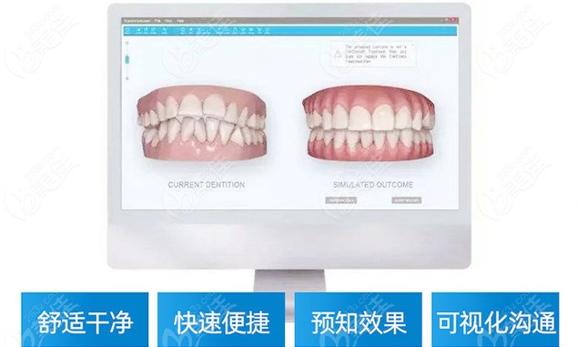 3D口扫模拟