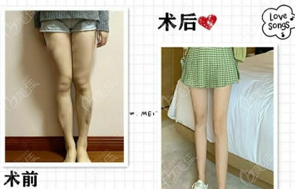 长沙星雅李雯大腿环吸前后<span style=