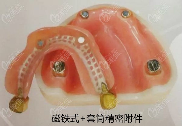 磁铁式+套筒精密附件