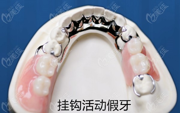 挂钩式活动假牙