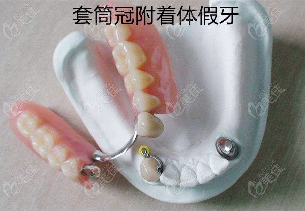 套筒冠附着体义齿