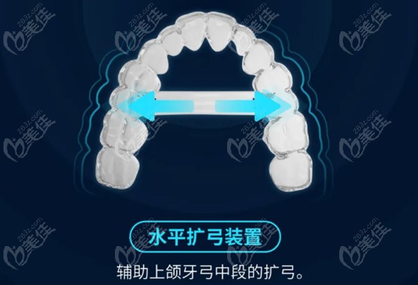 水平扩弓装置还可辅助上颌牙弓中段的扩弓