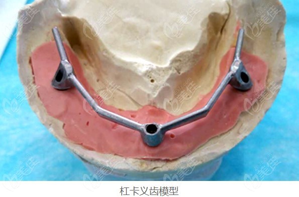 杆卡半固定种植牙模型