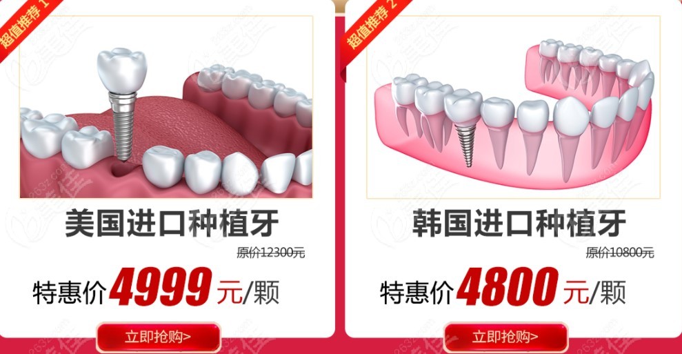 广州某大型口腔医院活动时种植牙的价格