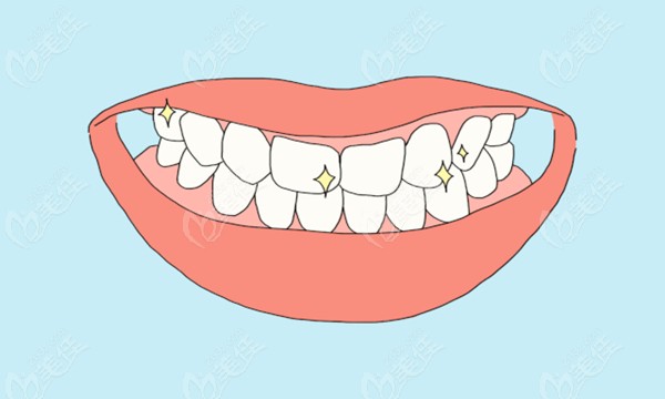 金华婺城区口腔医院周亚军医生的正畸病例-牙齿不整齐导致脸型不对称的矫治效果
