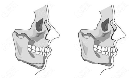 下巴截骨前移手術(shù)。