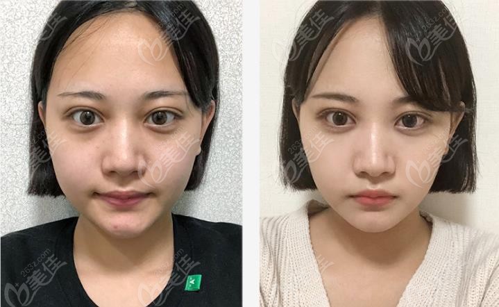 韩国普拉美斯整形医院双眼皮术后2天恢复照片