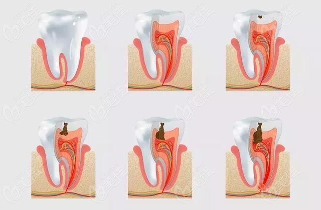 儿童牙齿龋坏过程