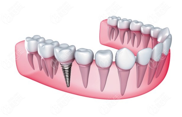 单颗牙齿缺失采用种植牙修复的图片