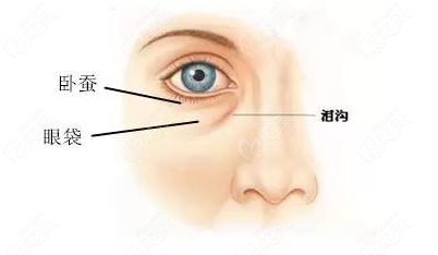 眼袋常见类型2：脂肪膨出型
