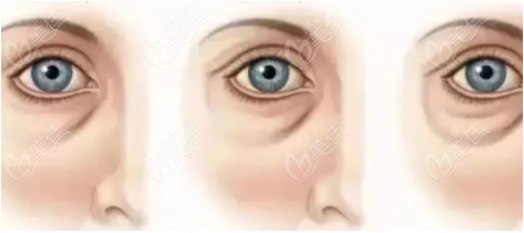 眼袋常见类型3：皮肤松弛型