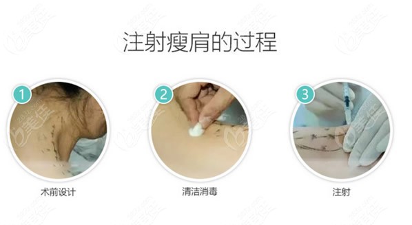 瘦肩的注射部位图解及过程