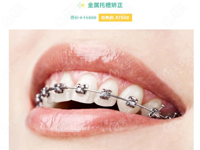 广州越秀区金属托槽牙齿矫正价格真是绝绝子您到圣贝口腔瞧瞧贵不贵呗
