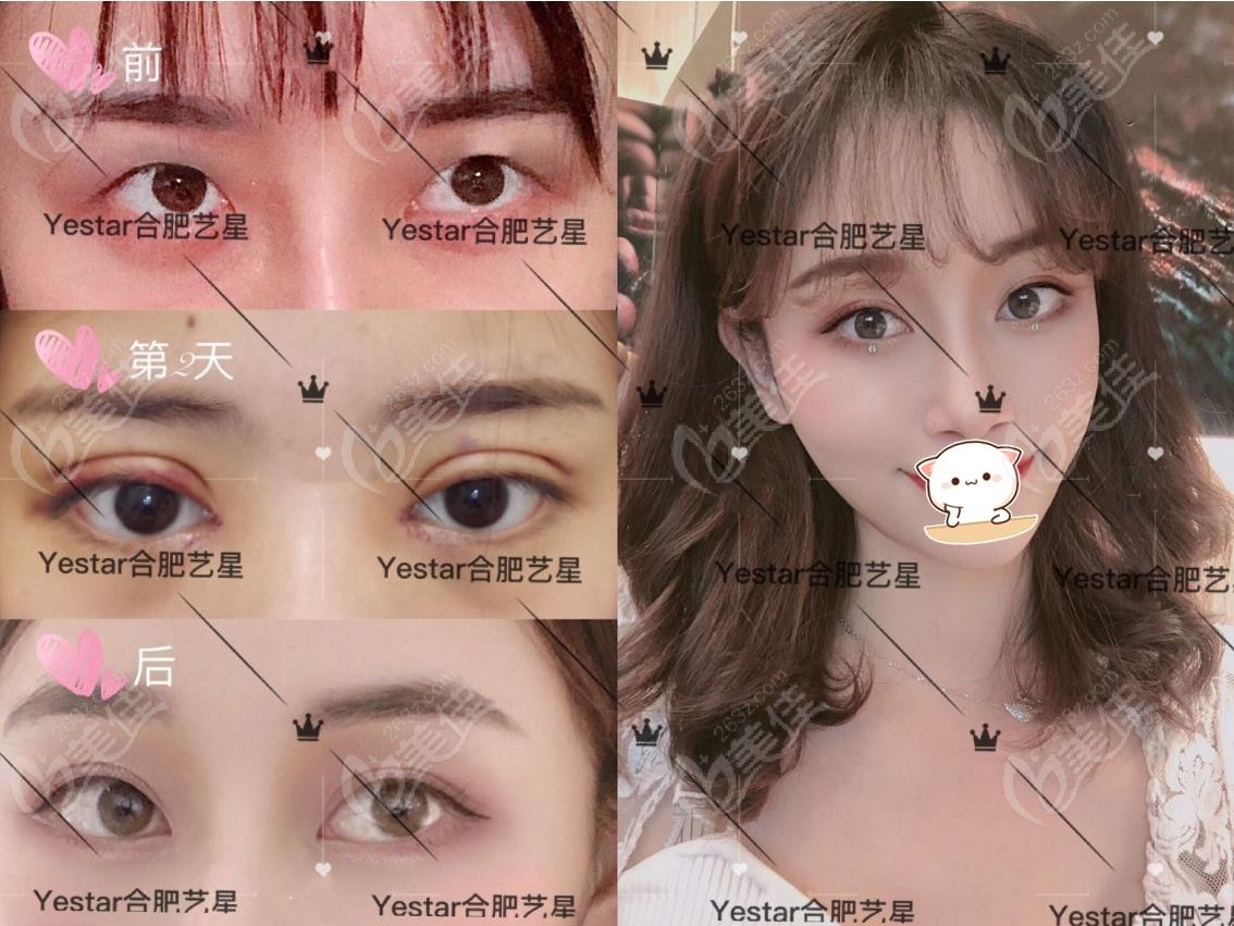 “美杜莎”、“韩式双眼皮”“桃花芭比眼”到底是什么技术？双眼皮术式了解一下 - 知乎