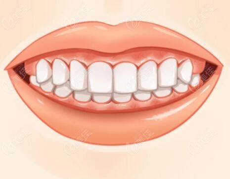 细说骨性龅牙分几级轻重度等程度划分图片全解析