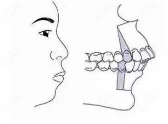 是由於牙槽骨突出造成,是常見的一類牙頜面畸形,在醫學上實質是上頜前