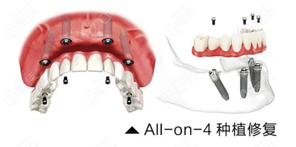 ALL- on-4种植牙技术的优势