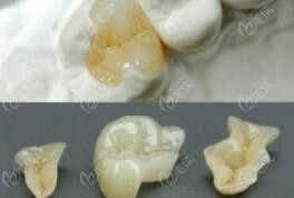 嵌体补牙