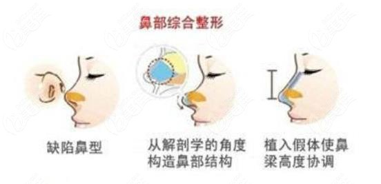 武海龙鼻综合手术特点