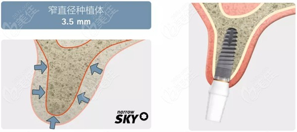 德国sky种植体narrow sky