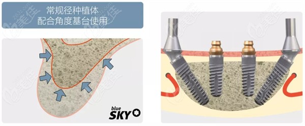 SKY种植体常规直径