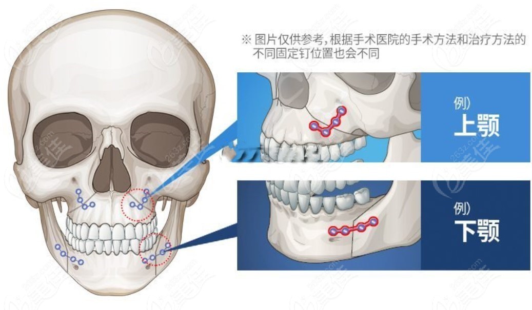 双鄂手术怎么做图解