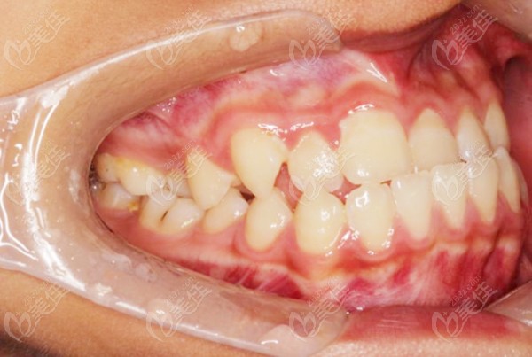 牙齿反颌矫正前的口内照