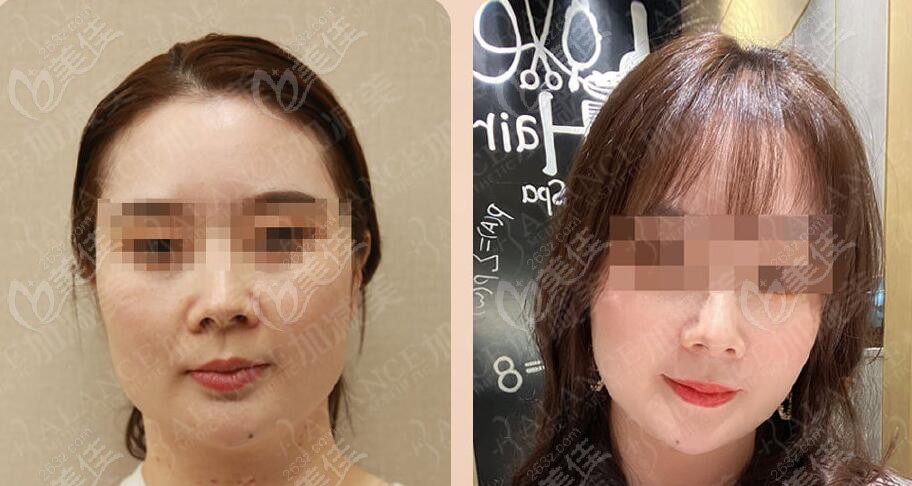 北京加减美v6面部提升实例
