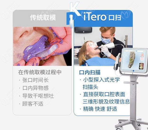 ITero数字化3D口扫设备对比传统取模的优势