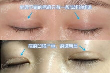 重庆时光双眼皮疤痕修复效果图