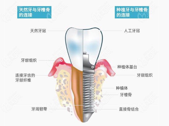 天然牙与种植牙的形态对比