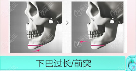 下巴截骨（下颏成型 ）手术价格