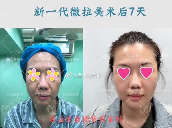 上海玺美医院微拉美面部拉皮手术第7天恢复图