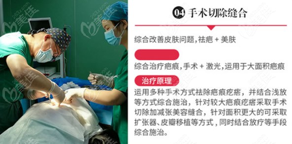 上海江城皮肤病医院手术切除疤痕原理