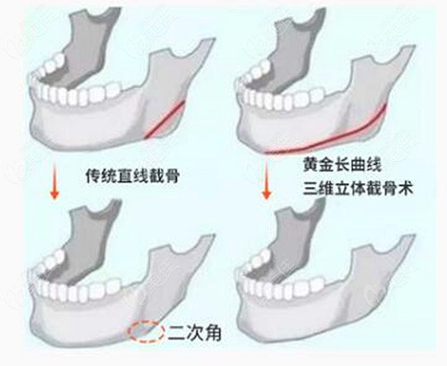 韓國(guó)一路美做磨骨的優(yōu)勢(shì)