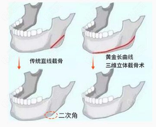 韩国一路美做磨骨的优势