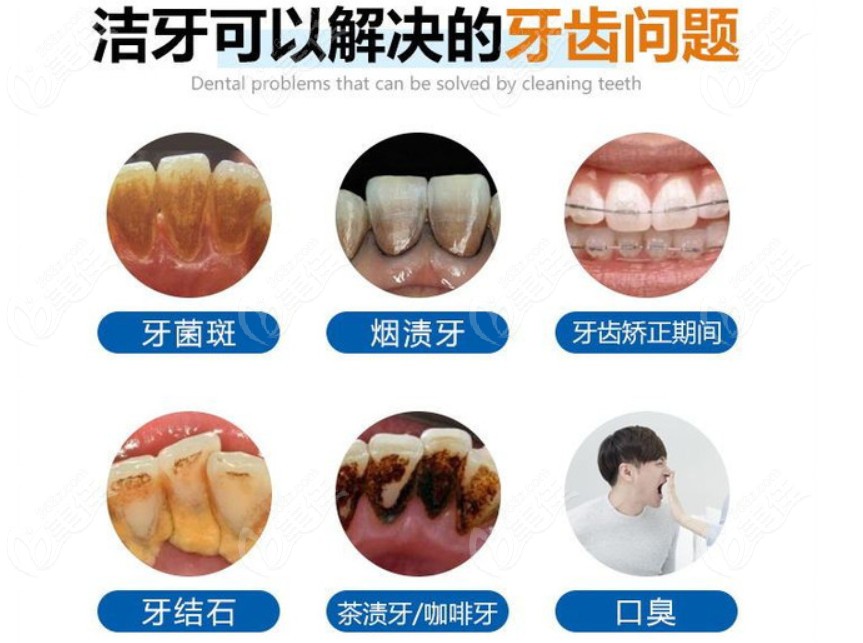 超声波洁牙的适应症都有哪些