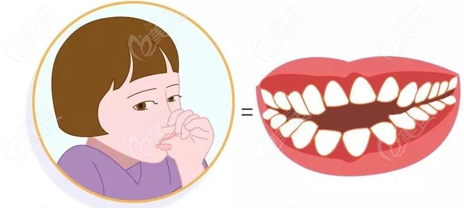 不良的口呼吸习惯导致牙齿不齐