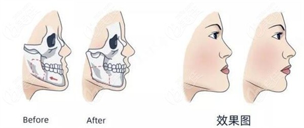 正颌手术改变面型