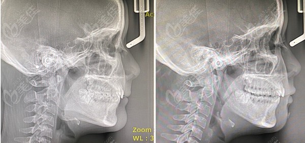 李运峰下颌角磨骨CT片效果