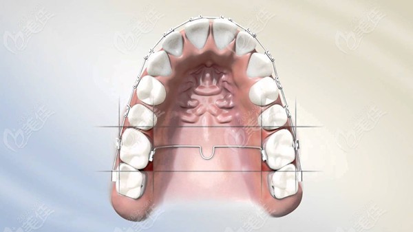 正畸腭弓式nance和tpa横腭杆区别在哪?细说作用和适应情况