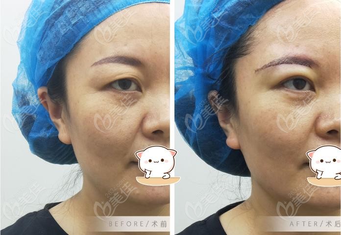 女人40岁双眼皮下垂了在阜阳光美做提眉手术补救的挺好,附效果图