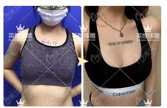 北京英煌脂肪豐胸真人圖片