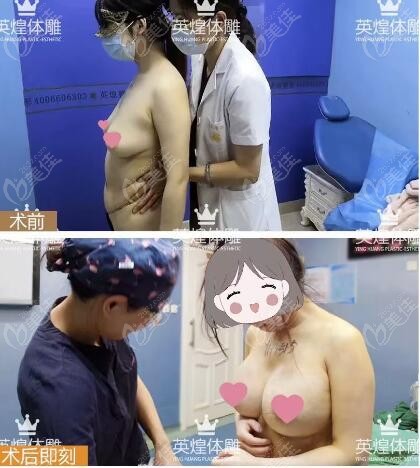 北京英煌做的脂肪隆胸即刻圖片