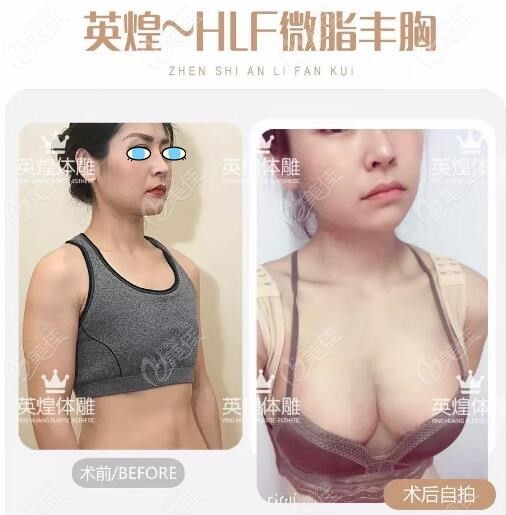 英煌做的脂肪隆胸前后變化圖片