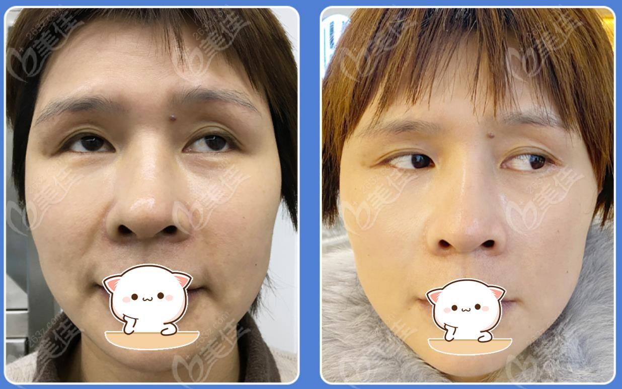 面部提升除皱效果好吗？北京加减美面部年轻化专科 - 哔哩哔哩