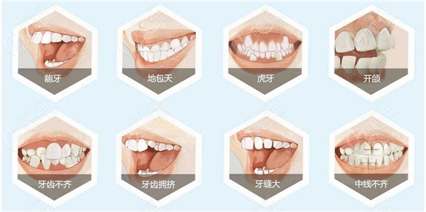 米兰口腔8种牙齿矫正畸形类型