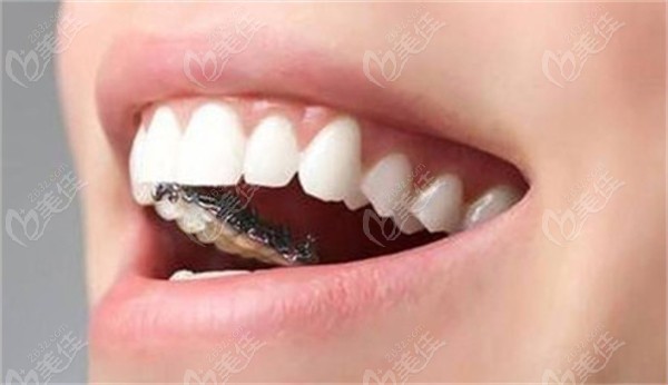 米兰口腔是怎么做舌侧矫正的
