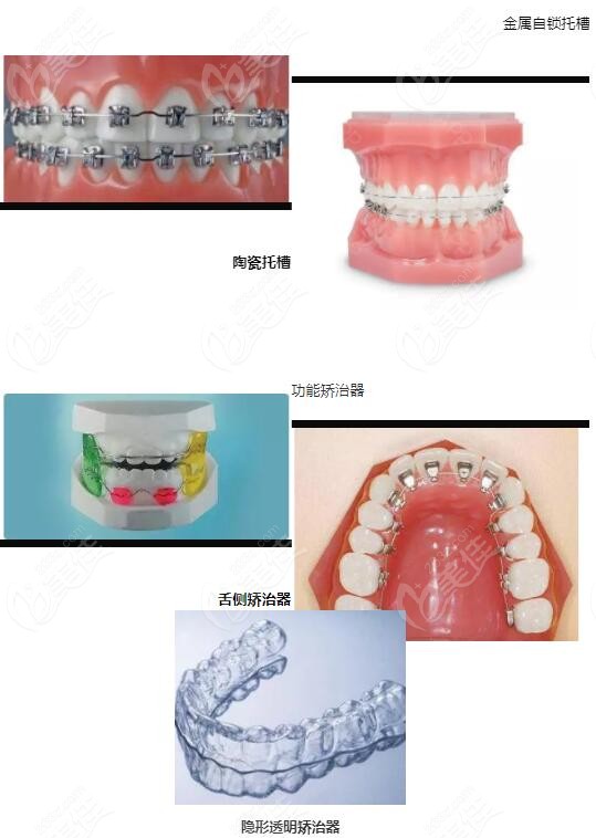 儿童矫治器的种类