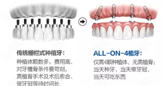 传统种植牙和all on 4种植牙对比